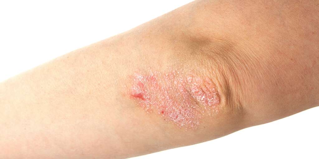 Psoriasis Specialist in Mclean, Virginia - Dr Yousefi