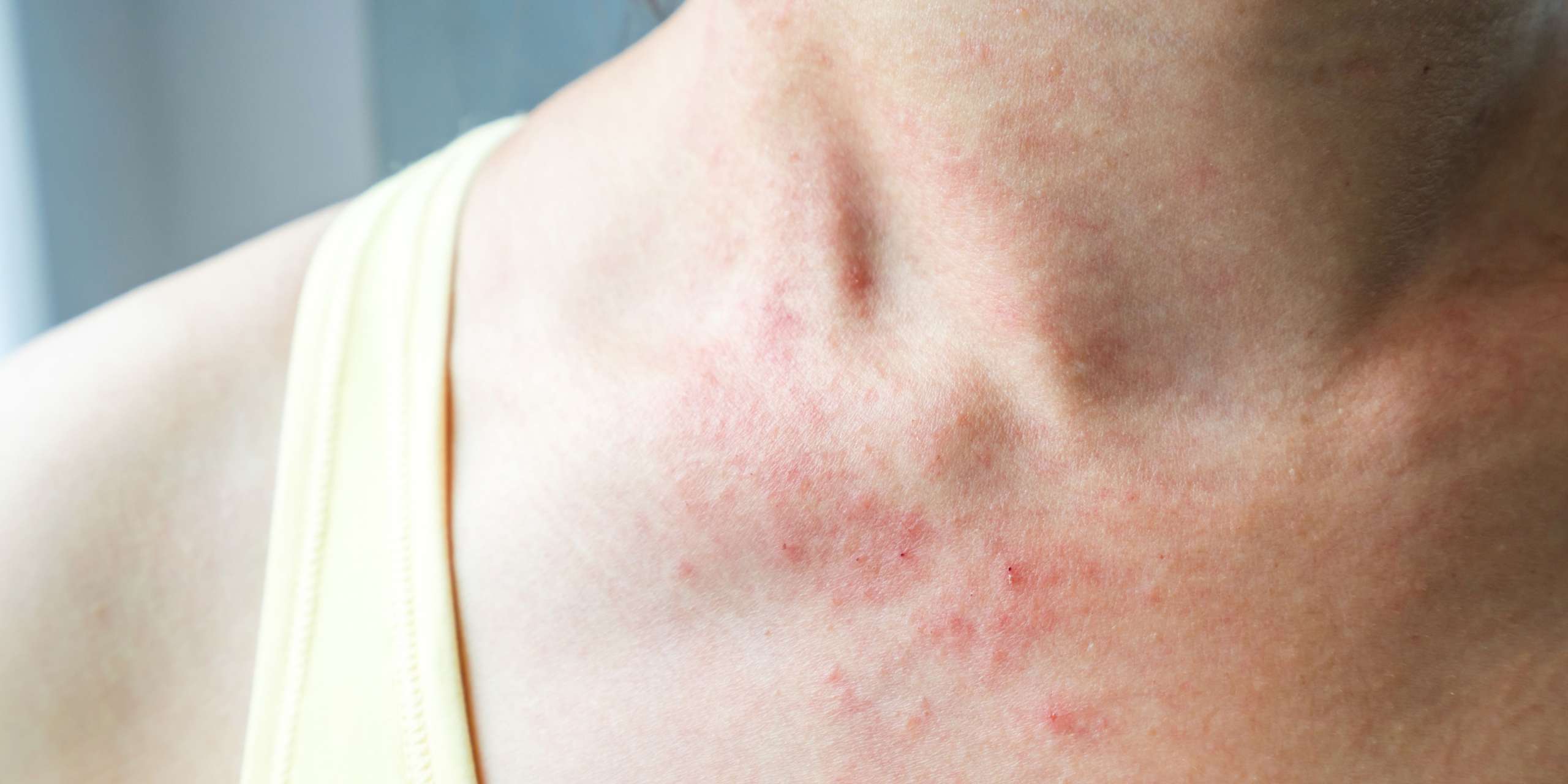 skin rashes