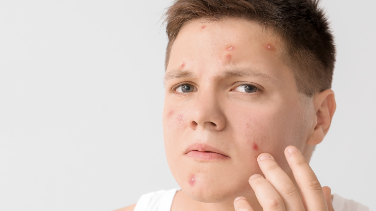 Get an Acne Appointment in Falls Church