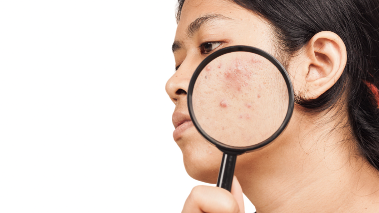 Adult Acne Specialist Near Great Falls