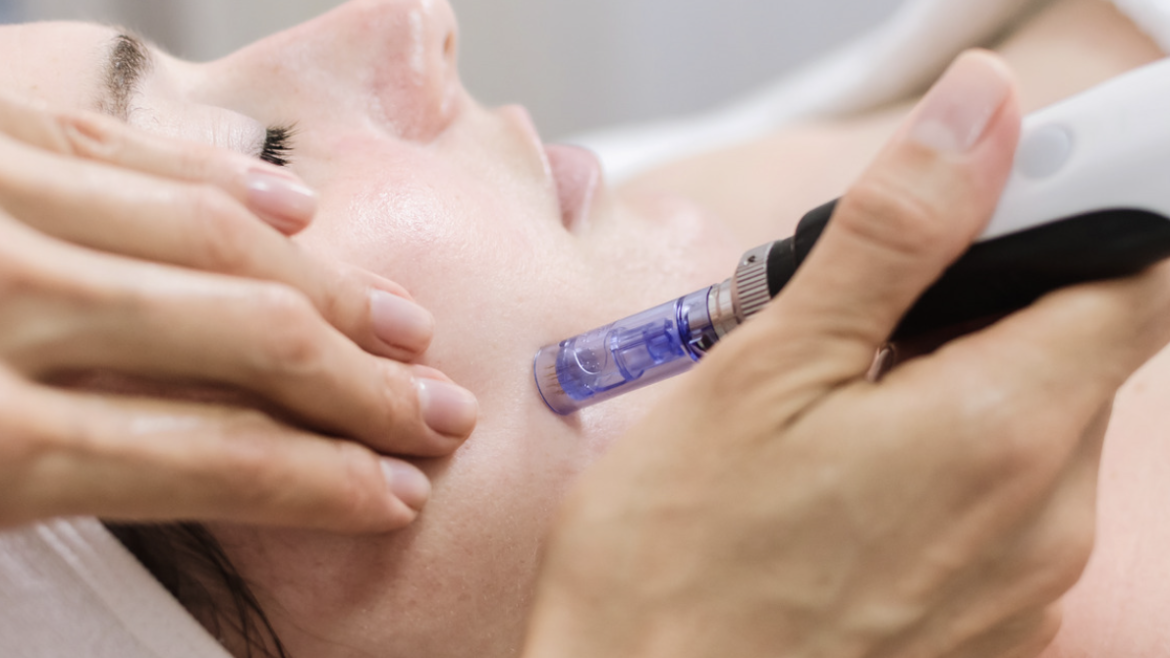 How Much Does Microneedling for Acne Cost in Vienna, VA?