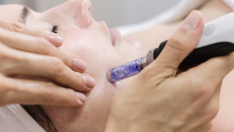 How Much Does Microneedling for Acne Cost in Vienna, VA?