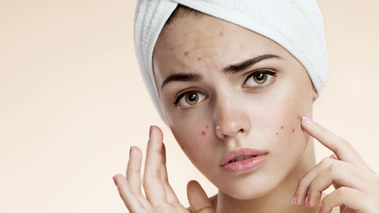 Top Dermatology Treatments for Acne Near Vienna and Falls Church