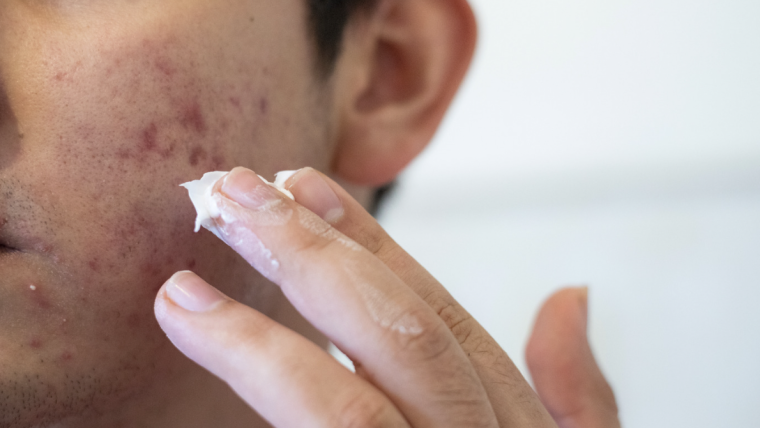 Choosing an Acne Specialist in Vienna and Falls Church