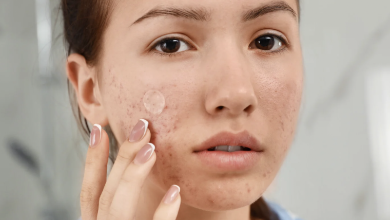 Treatments for Teen and Adult Acne in Vienna & Falls Church