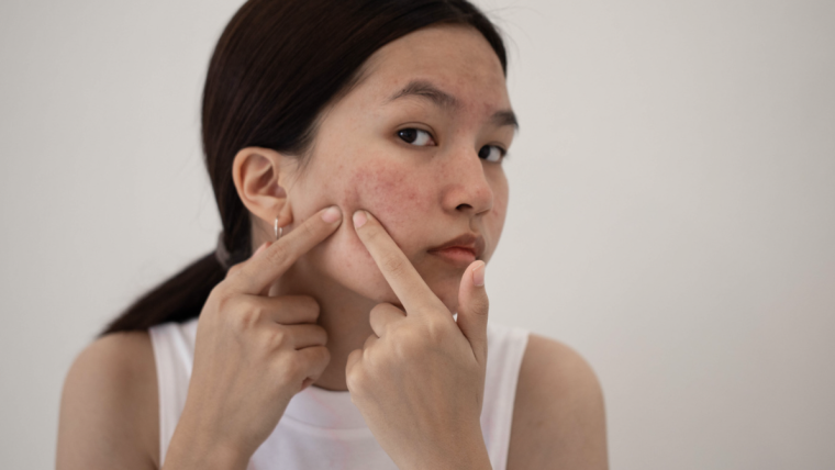 Same-Day Acne Treatment Appointments Available in Arlington