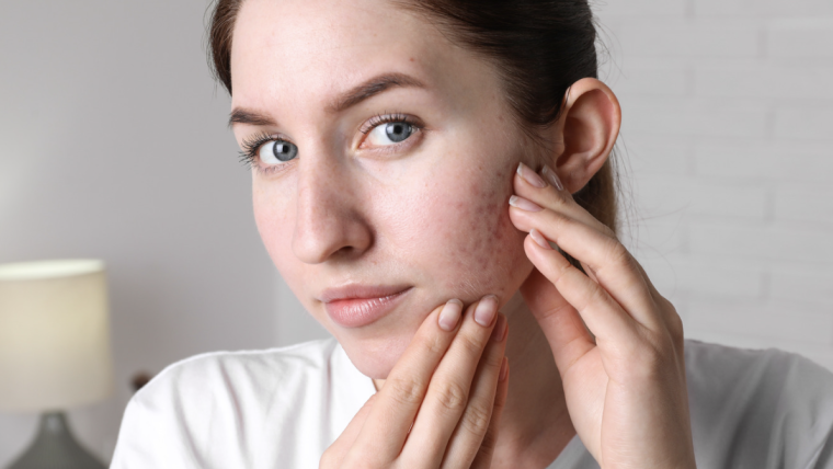 Fast and Effective Acne Treatments for Same-Day Relief