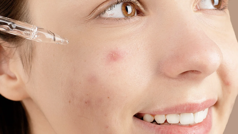 Same-Day Acne Appointment With a Top-Rated Dermatologist in McLean