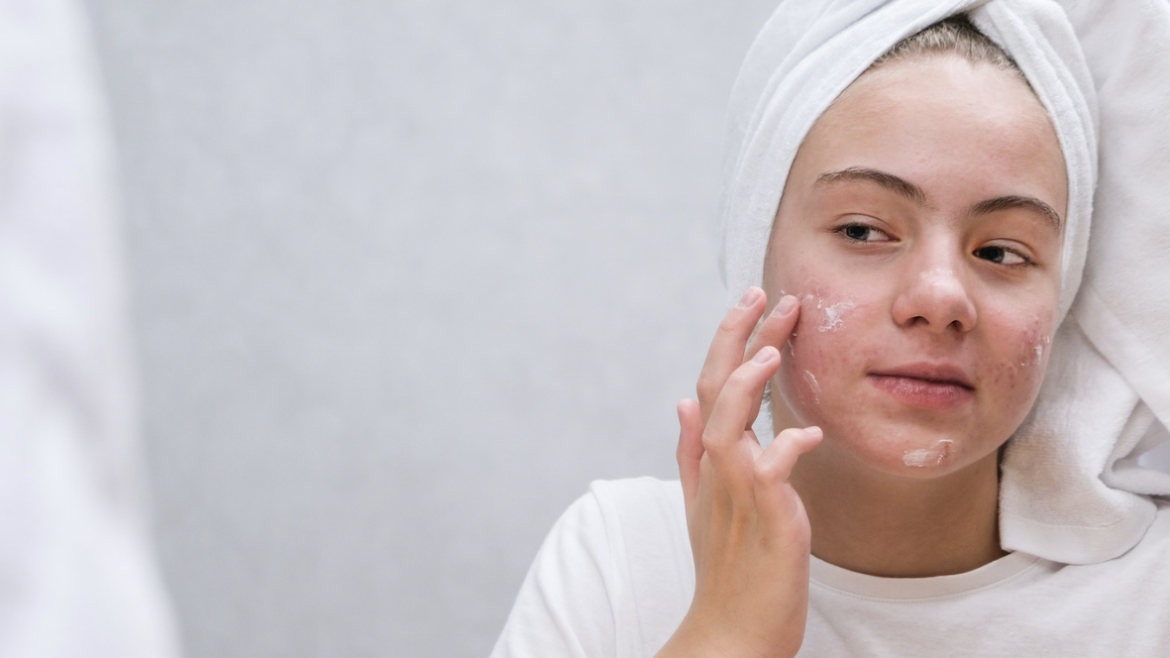 Fast and Effective Acne Treatments for Same-Day Relief