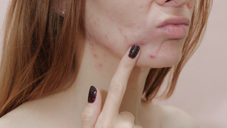 Best Acne Specialist Near McLean, VA for Clear and Healthy Skin