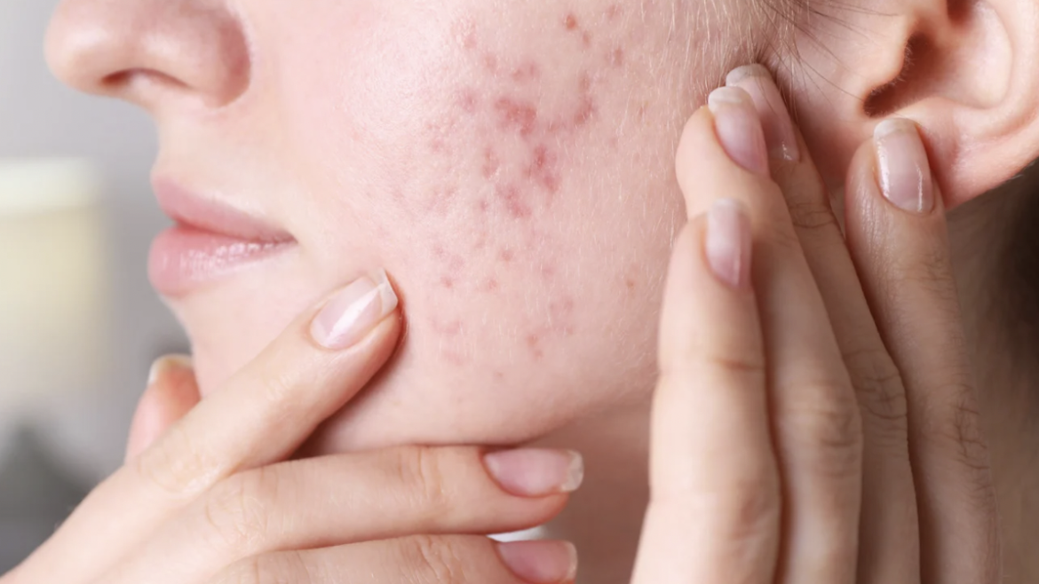 Top-Rated Dermatologist for Acne Treatment in McLean, VA