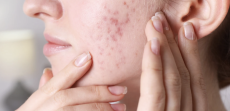 Top-Rated Dermatologist for Acne Treatment in McLean, VA